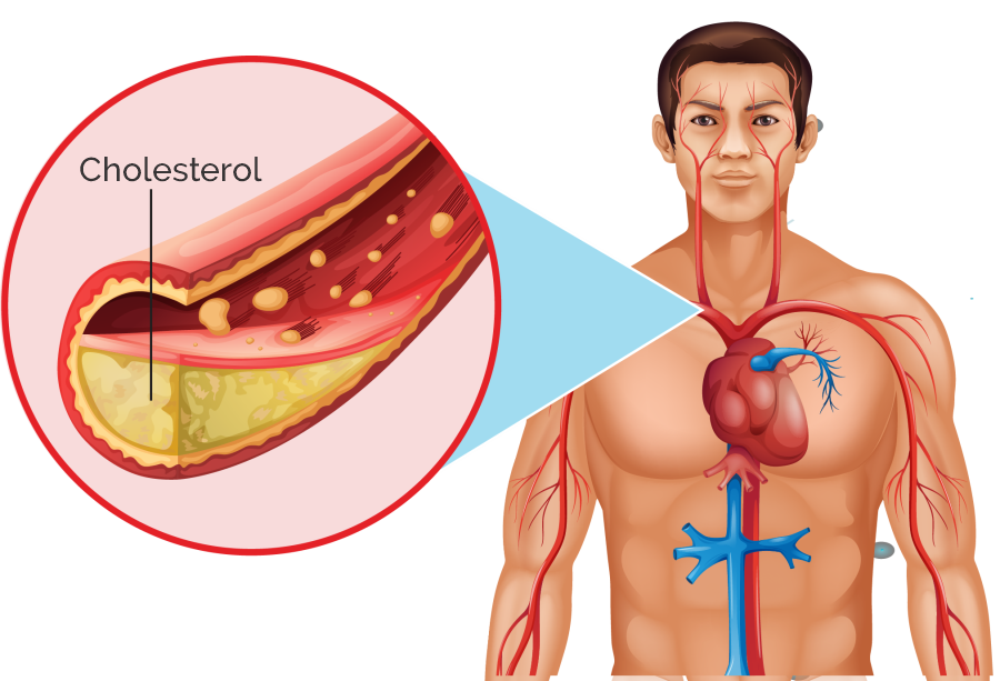 Cholesterol Levels Diagram